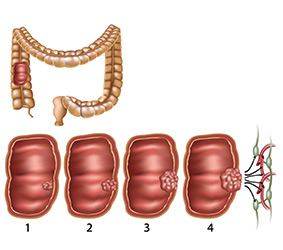 Diagram of colon and tumour growing inside the colon