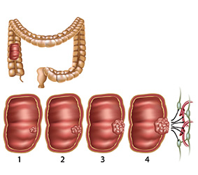 Diagramme du colon et d’une tumeur dans le colon